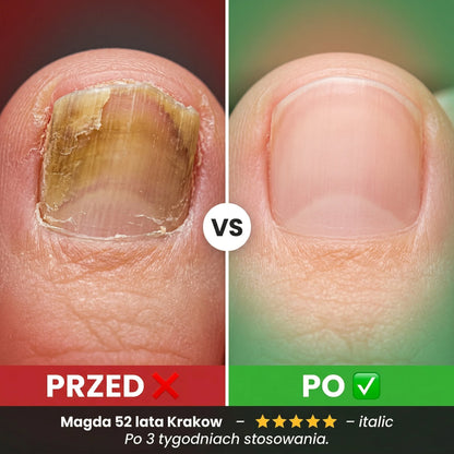 Plastry Hemios do zwalczania grzybicy, zwalczania paznokci oraz do korekcji wrastających paznokci